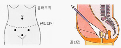 복강경 수술